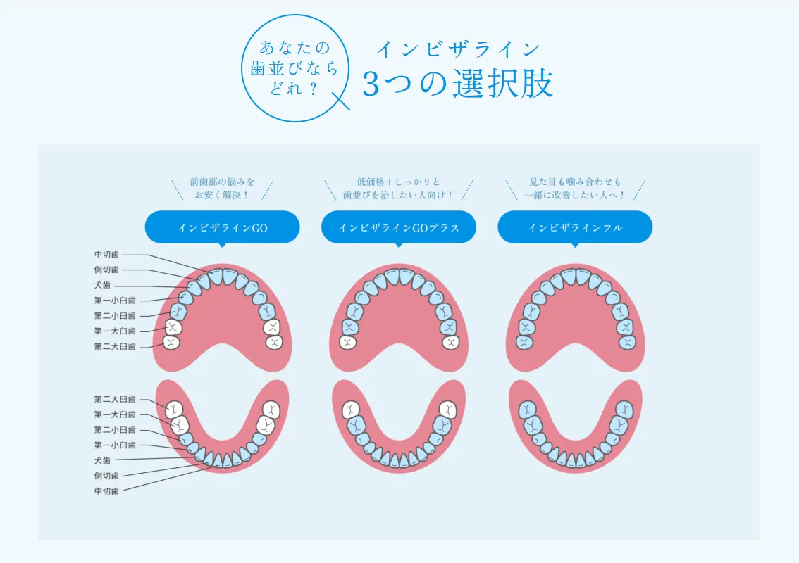 インビザライン3つの違い