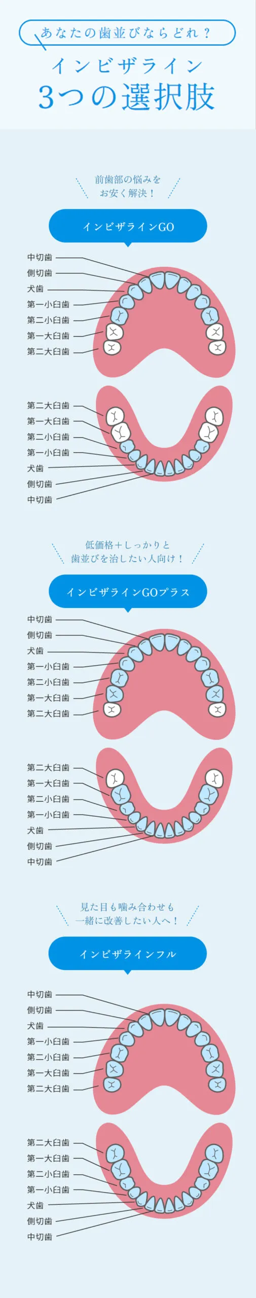 インビザライン3つの違い